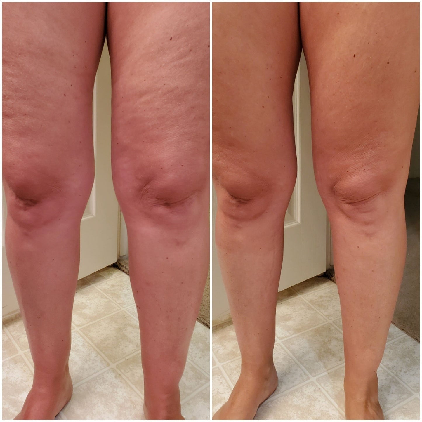 Before and after 30 days of TC1 Sculpting Gel and Collagen builder for smoother skin