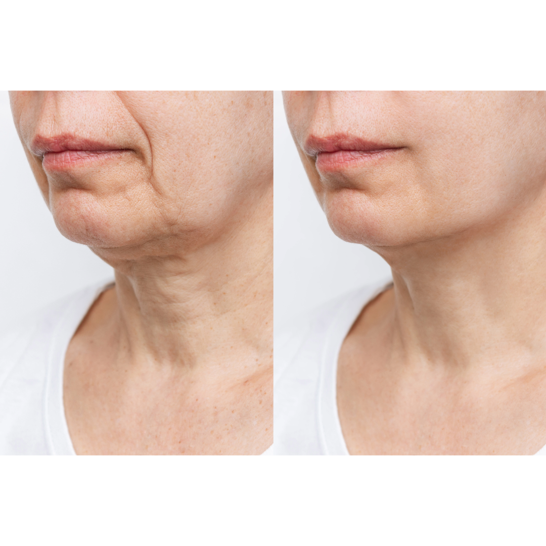 Tighten crepe skin around neck and face area with TC1 Sculpting Gel
